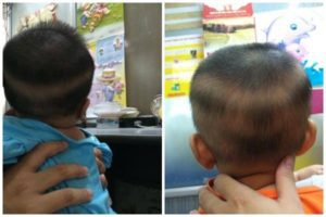 Cach dieu tri rung toc vanh khan o tre nho don gian va chuan nhat rungtoc 1501557954 width600height400