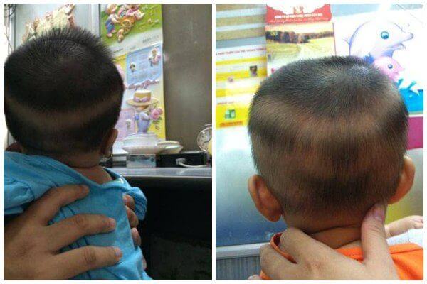 Trẻ ngộ độc vì cha mẹ bồi bổ vitamin d quá đà 1 Cach dieu tri rung toc vanh khan o tre nho don gian va chuan nhat rungtoc 1501557954 width600height400